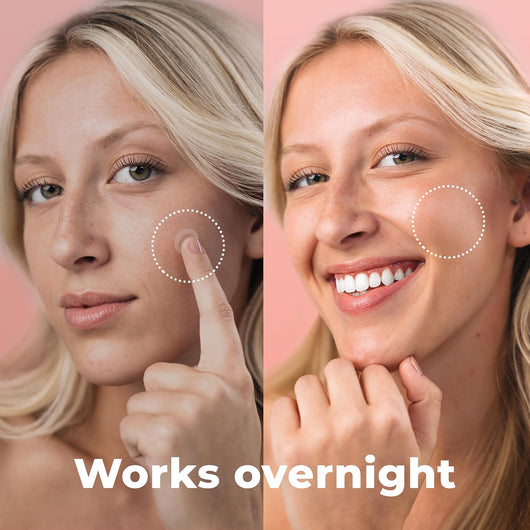 Micro Needle Pimple Patches